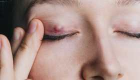 Come curare il calazio con metodi naturali e alimentazione