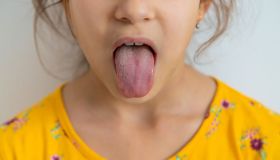 Le malattie che possono causare la lingua bianca nei bambini