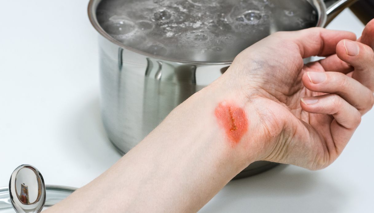 Bruciature, scottature e piccoli ustioni: rimedi naturali