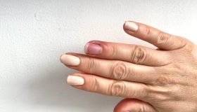 Patereccio o giradito: cos’è e come si cura