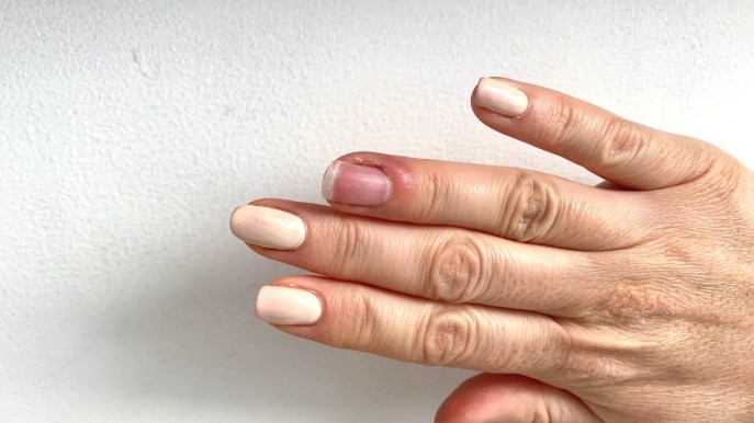 Patereccio o giradito: cos’è e come si cura