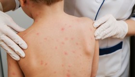 Le sei malattie esantematiche dei bimbi, come riconoscerle e cosa fare