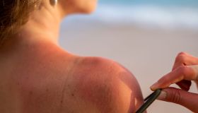 Eritema solare: quando si manifesta e come curarlo