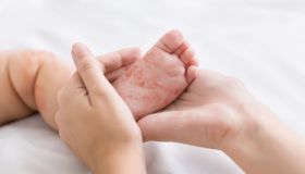 Morbillo: quali sono i sintomi e come riconoscerlo