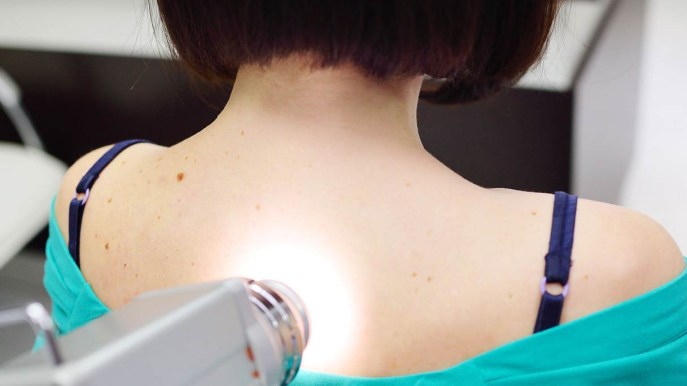 Cheratosi: cos’è, manifestazioni e cure