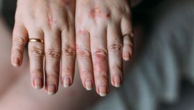 Dermatite atopica: definizione, perché si manifesta e quali sono le cause