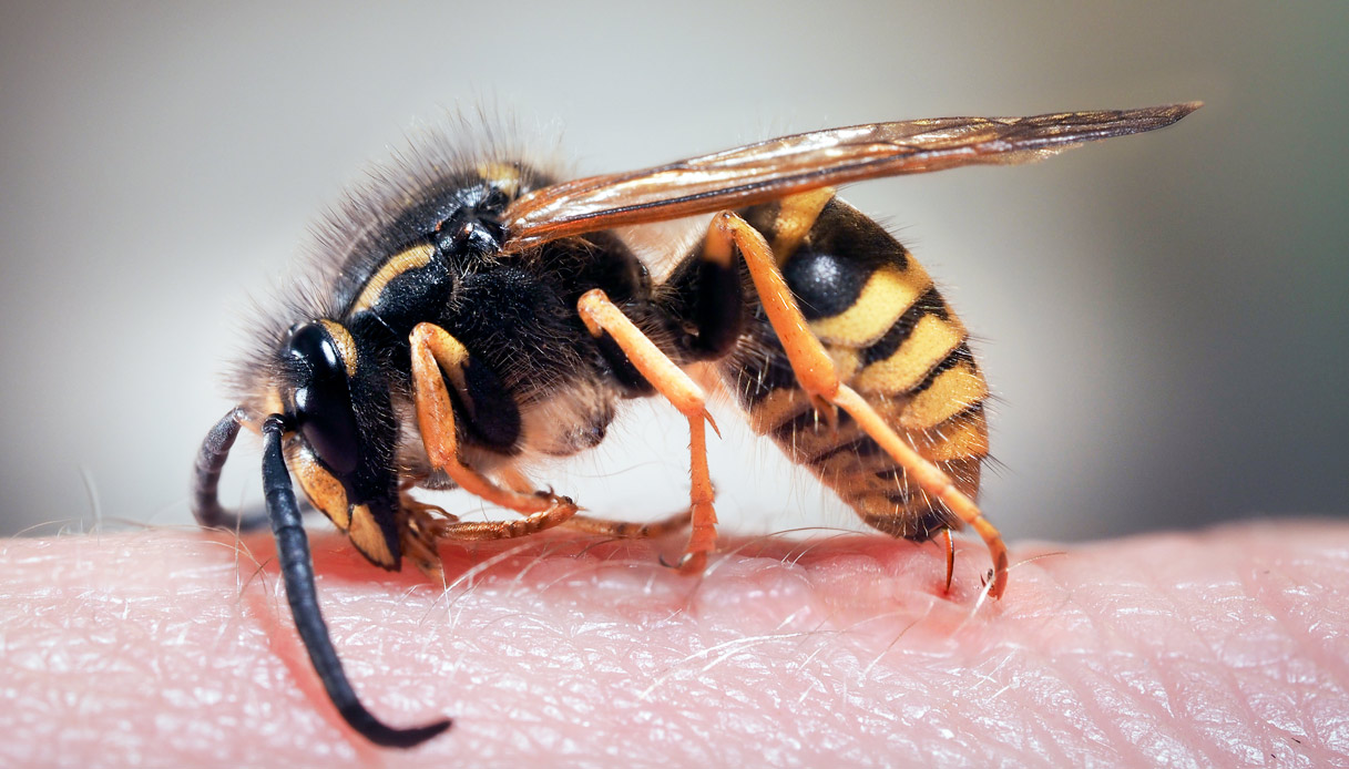 Anafilassi, cos’è e chi rischia di più lo shock anafilattico