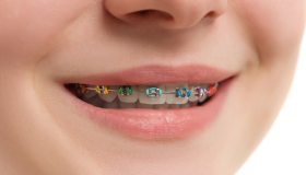 Apparecchio ai denti: a quale età e in quali casi è consigliabile metterlo