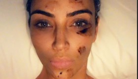 Kim Kardashian e la lotta alla psoriasi: “Combatto così”