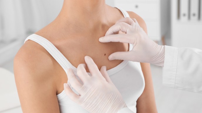 Come prevenire il rischio melanoma: prendere il Sole con giudizio