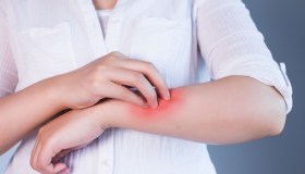 Bruciature, ecco perché il dolore rimane a lungo