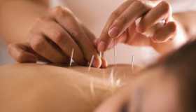 Agopuntura: cos’è, benefici e come si svolge una seduta