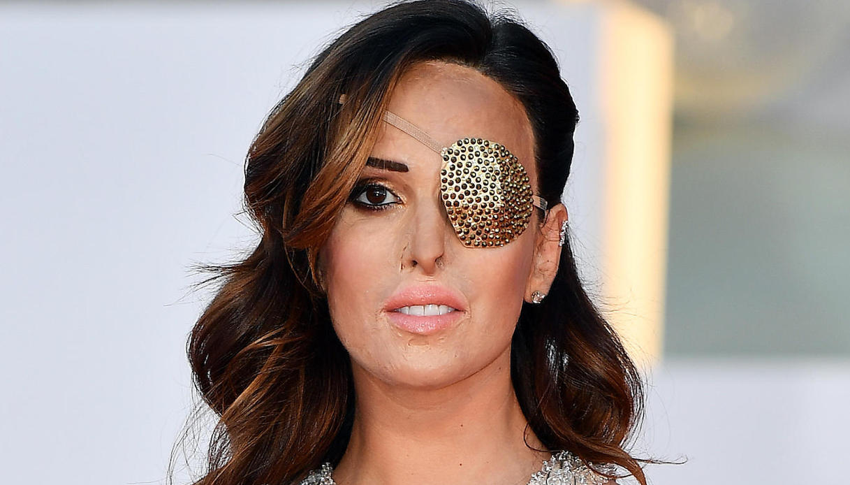 Verissimo, Gessica Notaro: “Oggi ho un occhio coperto ma ci vedo più di prima”