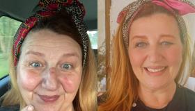 Un mese di sleeve gastrectomy, vi racconto il mio percorso