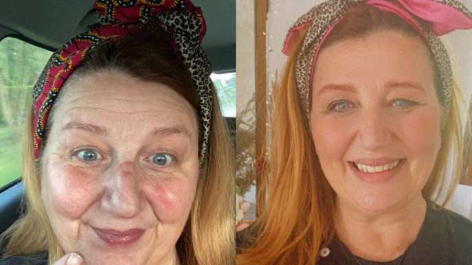 Un mese di sleeve gastrectomy, vi racconto il mio percorso