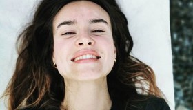 Vitiligine: le celeb che ne hanno fatto un punto di forza