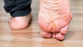 Occhio di pernice: cos’è, cause e rimedi naturali