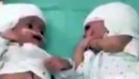 Gemelline siamesi si separano: il loro primo sguardo