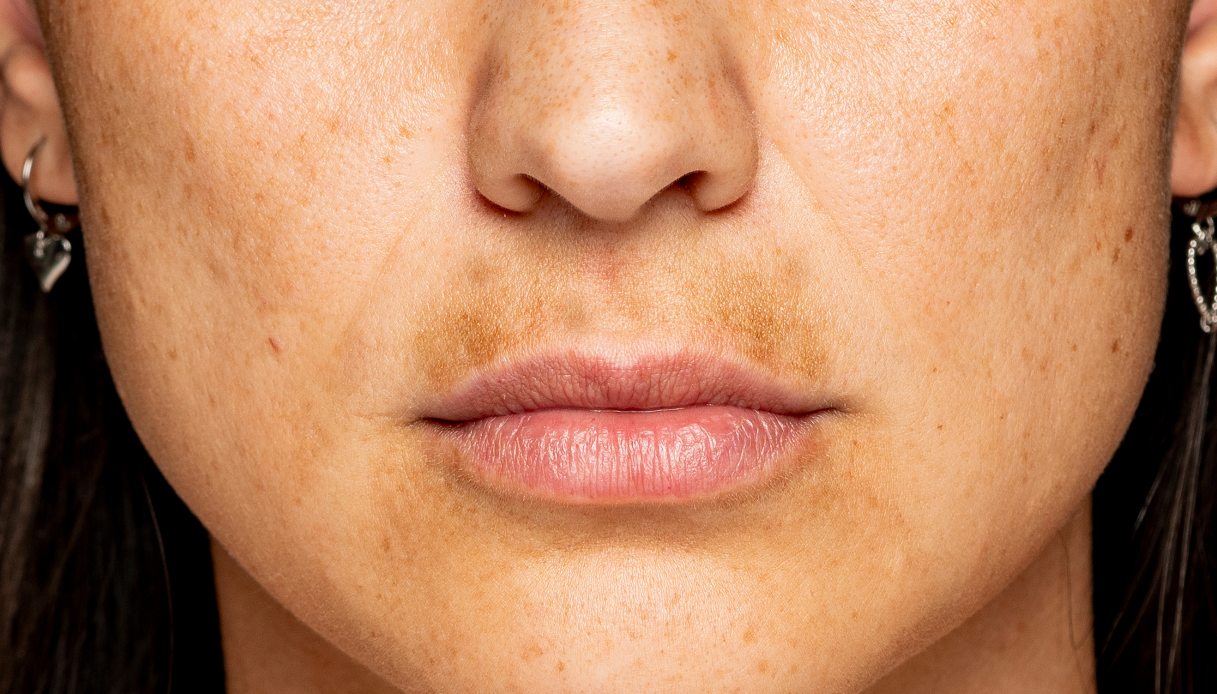 Macchie della pelle: quali rimedi naturali?