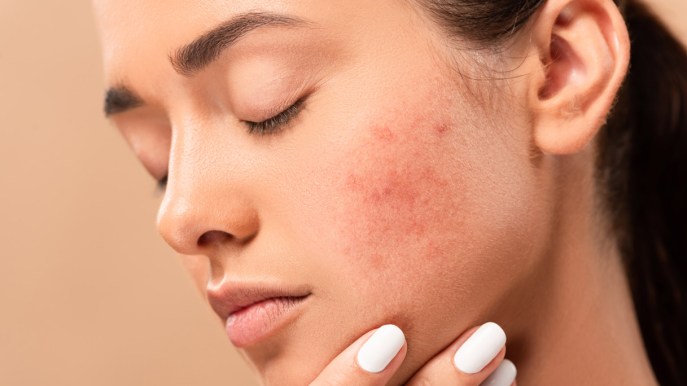 Acne, così in futuro affronteremo i “punti neri”