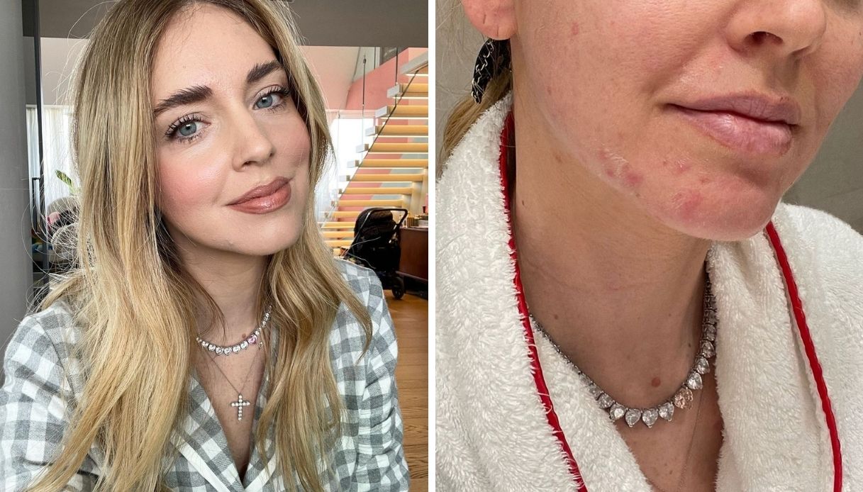 Chiara Ferragni e lo sfogo di acne: “La mia più grande preoccupazione”