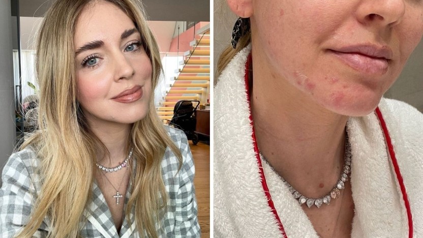 Chiara Ferragni e lo sfogo di acne: “La mia più grande preoccupazione”