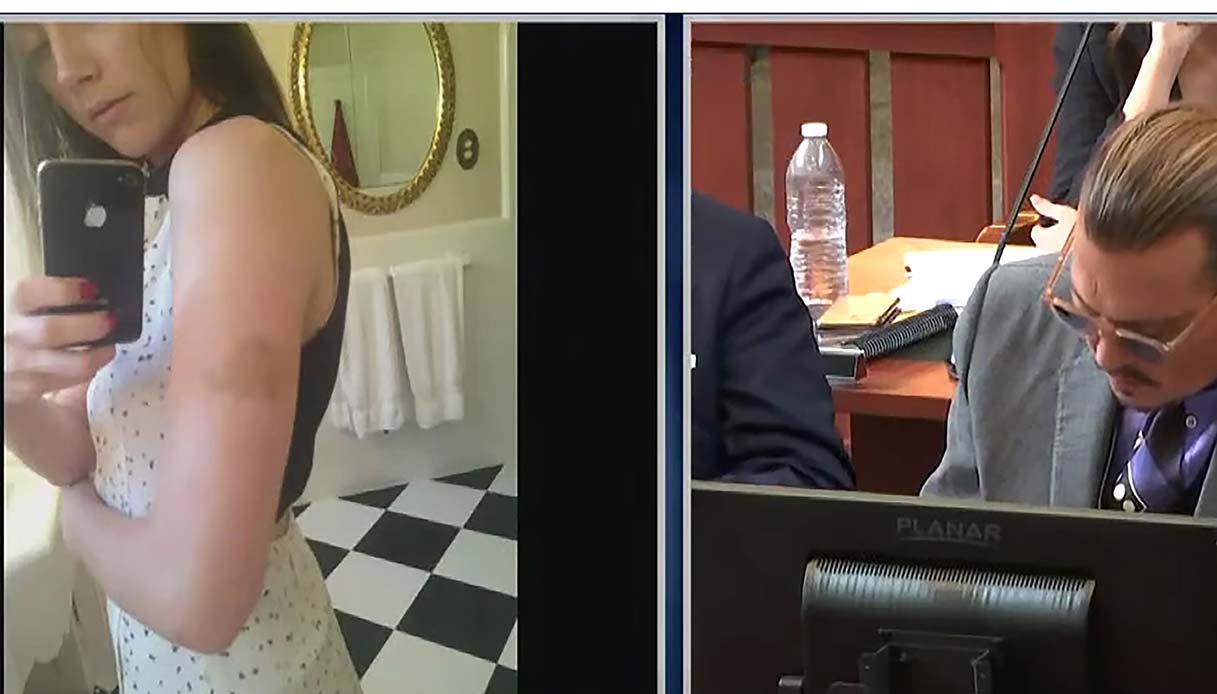 Amber Heard: le foto delle botte di Depp