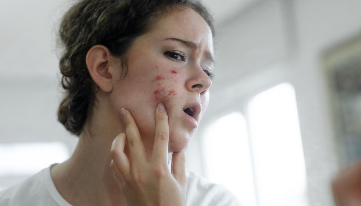 ragazza pelle con acne
