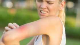 Punture di vespe e api: i rimedi naturali che funzionano