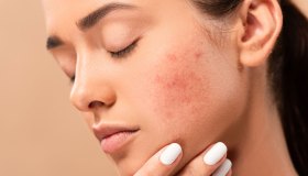 Celiachia nei giovani, attenzione ai segni sulla pelle