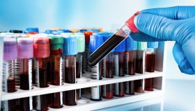 Biopsia liquida: cos’è, dove farla, a cosa serve