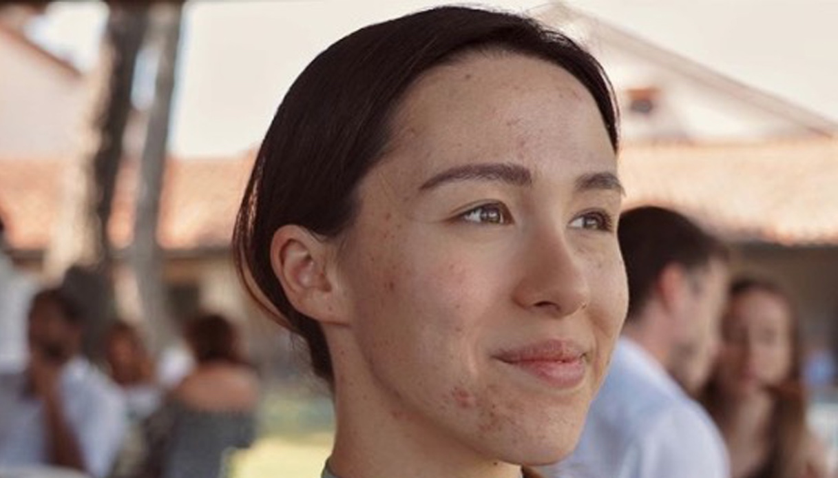 Aurora Ramazzotti e l’acne dopo il parto: la lezione di accettazione