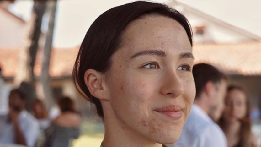 Aurora Ramazzotti e l’acne dopo il parto: la lezione di accettazione