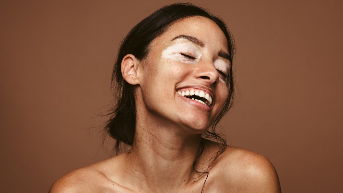 Se hai la vitiligine prendi il sole così per un’abbronzatura perfetta