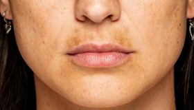 Come prevenire le macchie scure del viso e ridurle con prodotti e trattamenti