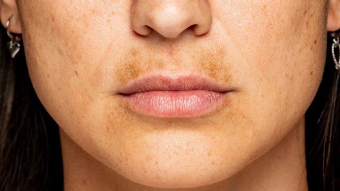 Come prevenire le macchie scure del viso e ridurle con prodotti e trattamenti