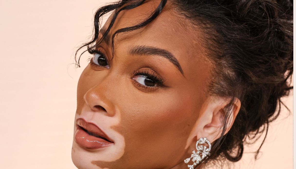 Winnie Harlow, la modella con la vitiligine sfida i pregiudizi con l’abito “vedo-non vedo”