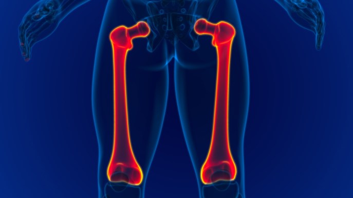Frattura del femore, perché i rischi crescono con l’età e quanto pesa l’osteoporosi