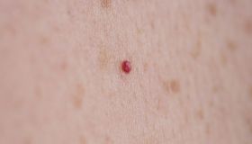 Angioma: definizione, classificazioni e cause