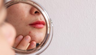 L’ittiolo fa davvero scomparire i brufoli? Cos’è e come usarlo in sicurezza