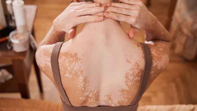 Vitiligine, il Manifesto in 5 punti per saperne di più e gestire la patologia