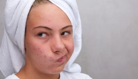 Acne: sintomi, tipologie e trattamenti