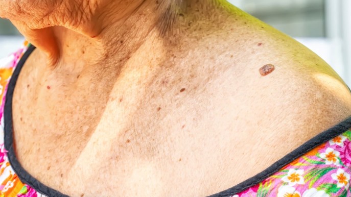 Basalioma: cos’è, sintomi, terapie