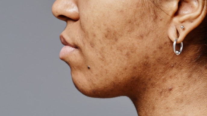 Cicatrici da acne: tipologie e rimedi