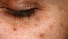 Cloasma della pelle: che cos’è, cause e trattamenti