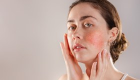 Couperose: cos’è, cause, prevenzione e rimedi