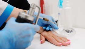 Crioterapia con azoto liquido: cos’è, a cosa serve e quando farla