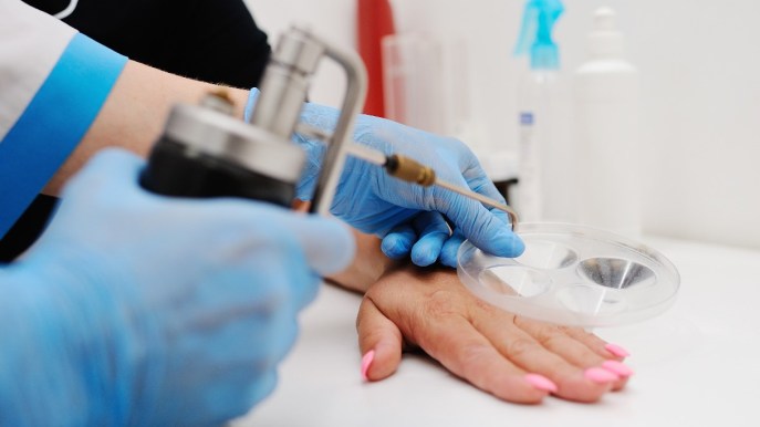 Crioterapia con azoto liquido: cos’è, a cosa serve e quando farla