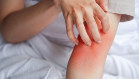 Dermatite atopica, come ricevere consulenze dermatologiche gratuite