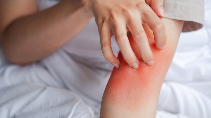 Dermatite atopica, come ricevere consulenze dermatologiche gratuite